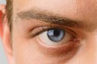 Cataracts