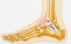 Home Remedies for Ankle Swelling