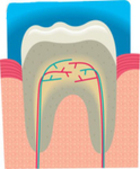 Reasons for Dentists Recommending Dental Crowns