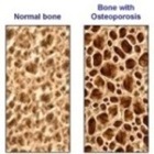 Eric Bakker - Osteoporosis (Part 2)