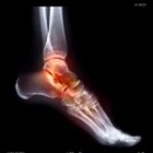 Glucosamine and Pain Relief