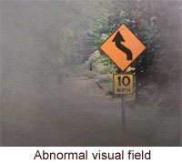 abnormal visual field