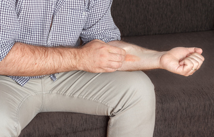 Man scratching an eczema on his hands, medical concept
