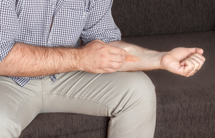 Man scratching an eczema on his hands, medical concept