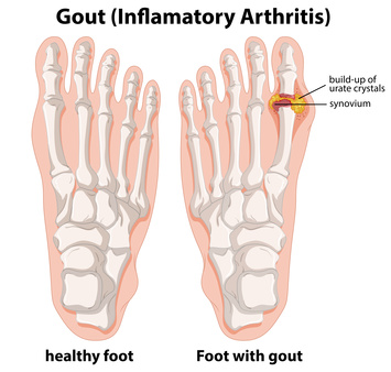 Diagram explanation of Gout in human foot
